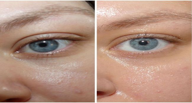 the ordinary multi peptide serum before and after